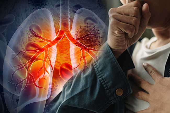 පෙනහළු පිළිකා ගැන භයානක අනාවරණයක්