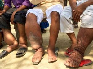 2025 වසරේදී මෙරටින් බරවා රෝගීන් 68ක්